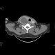 Cyst of the thyroid gland: CT - Computed tomography